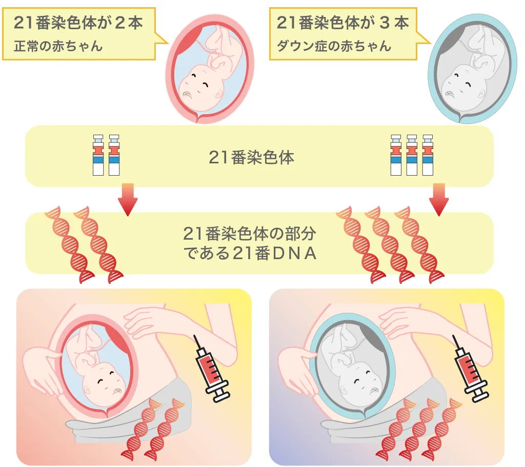 21トリソミー